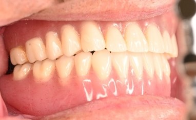 マグネット義歯