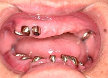 マグネット義歯