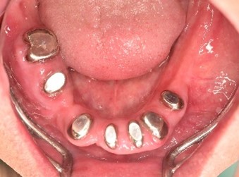 マグネット義歯