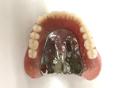 マグネット義歯