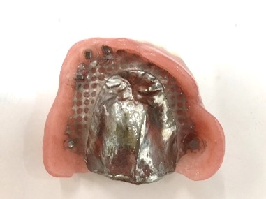 マグネット義歯