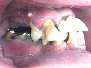 マグネット義歯