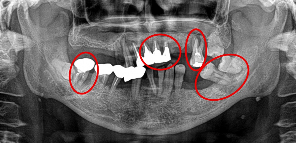 マグネット義歯