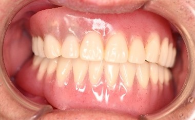 マグネット義歯