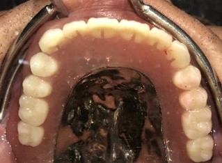 マグネット義歯