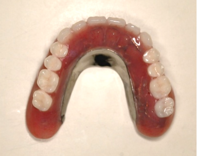 マグネット義歯