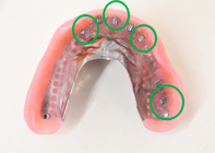 マグネット義歯