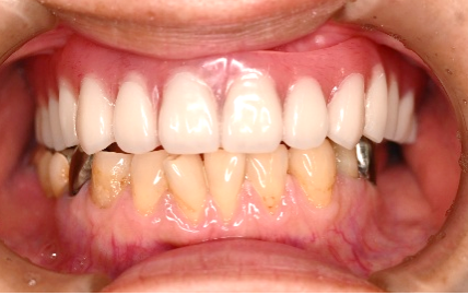 マグネット義歯