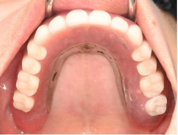 マグネット義歯