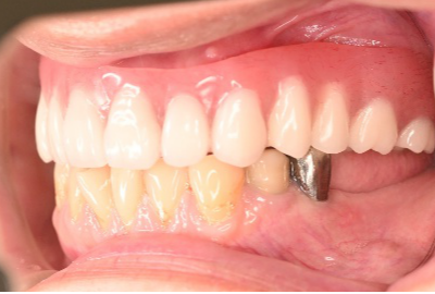 マグネット義歯