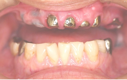 マグネット義歯