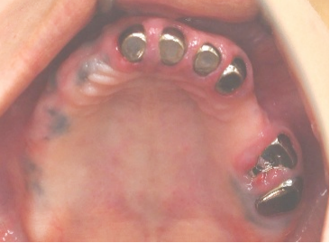 マグネット義歯