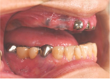 マグネット義歯