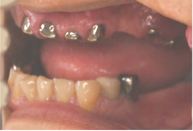 マグネット義歯