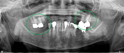 マグネット義歯