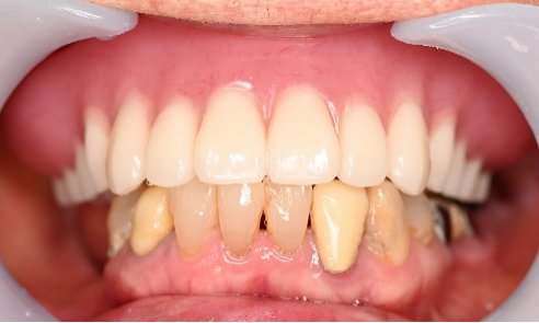 マグネット義歯