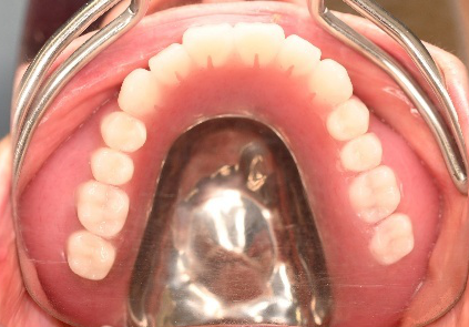 マグネット義歯