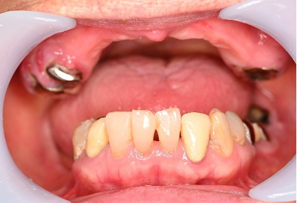 マグネット義歯