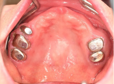 マグネット義歯