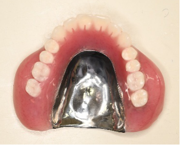 マグネット義歯