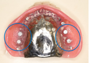 マグネット義歯