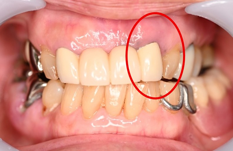 スマートデンチャー