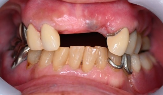 スマートデンチャー