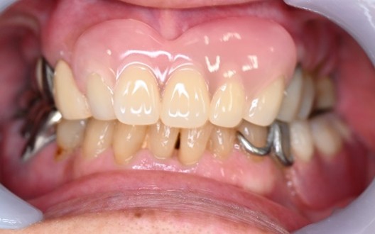 スマートデンチャー