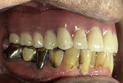 マグネット義歯