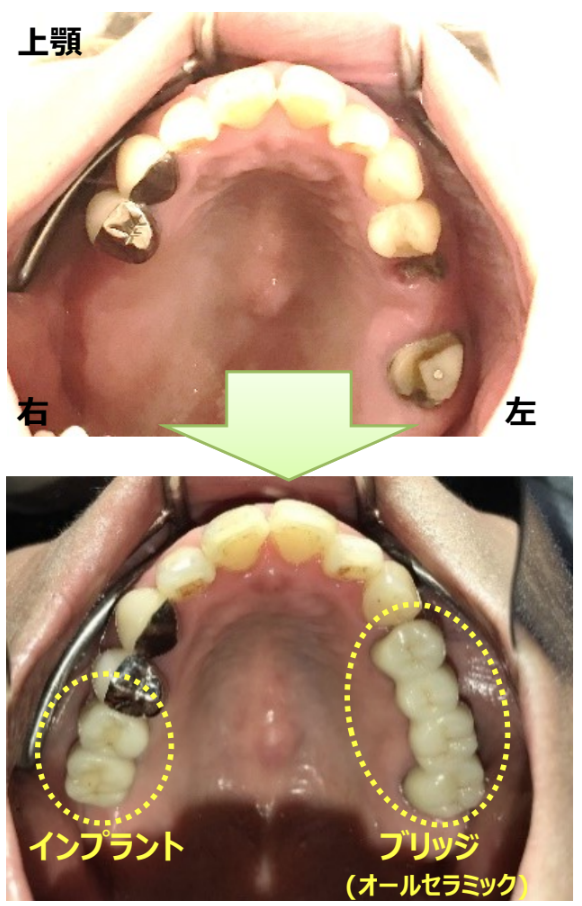 インプラントとブリッジ