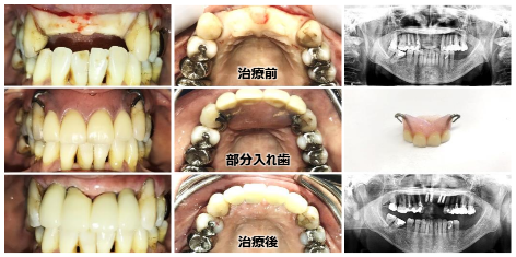 今まで部分入れ歯だったところをインプラントへ！