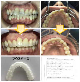 今まで部分入れ歯だったところをインプラントへ！