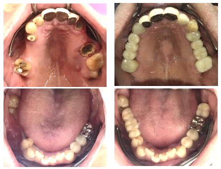 マグネット式入れ歯