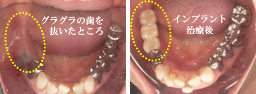 インプラント治療