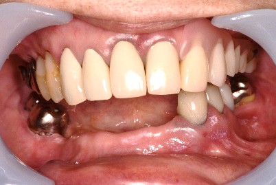 スマートデンチャー