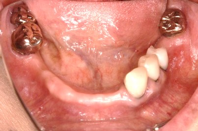 スマートデンチャー