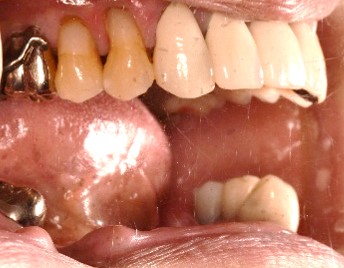 スマートデンチャー