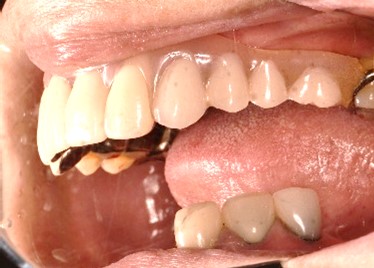 スマートデンチャー