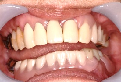 スマートデンチャー