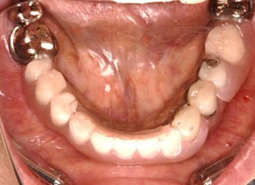 スマートデンチャー