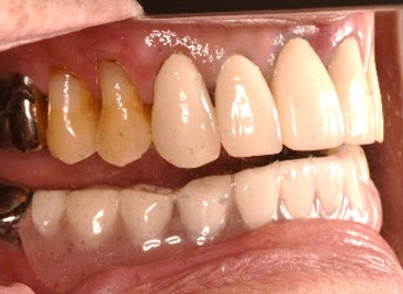 スマートデンチャー