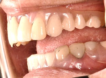 スマートデンチャー