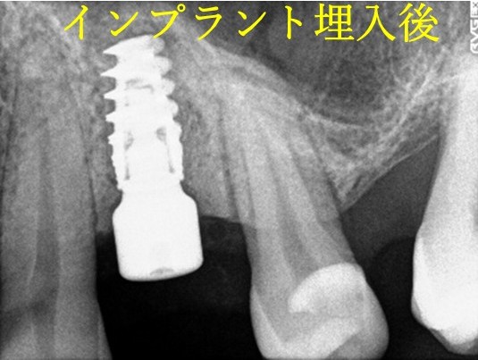 インプラント