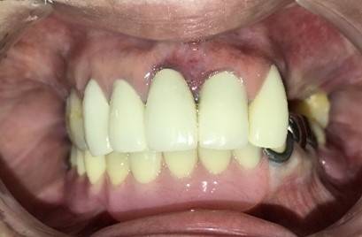 スマートデンチャー