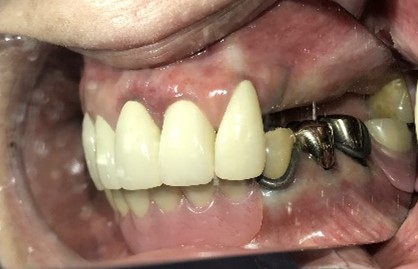 スマートデンチャー