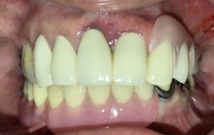 スマートデンチャー