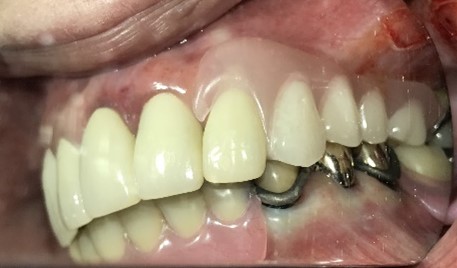 スマートデンチャー