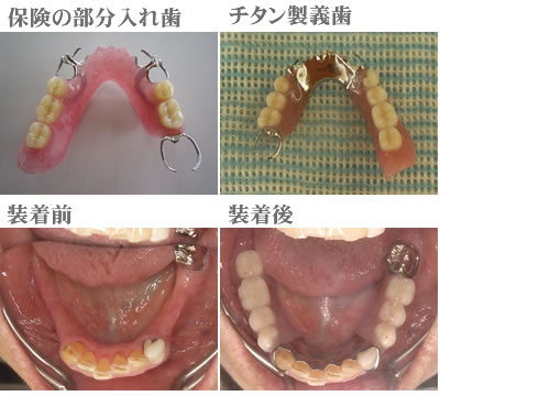 チタン製義歯