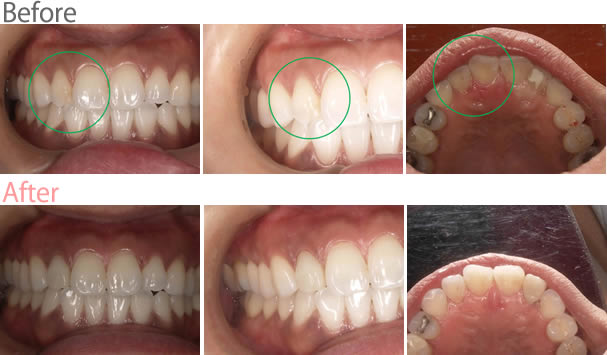 オールセラミック冠