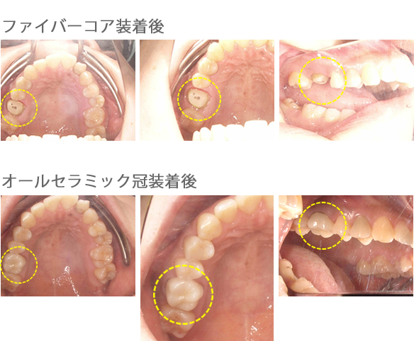 オールセラミック冠
